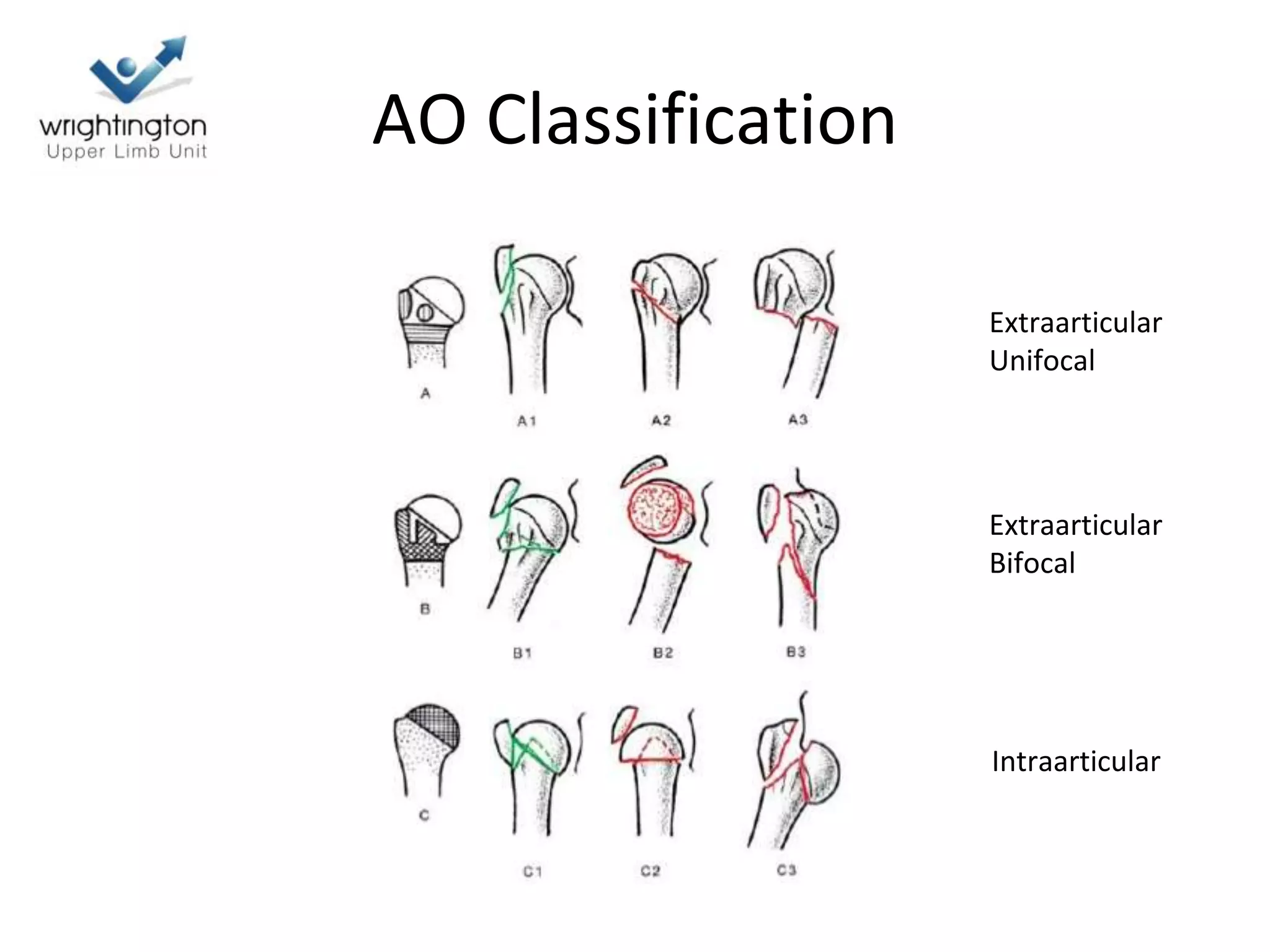 AO Classification
Extraarticular
Unifocal
Extraarticular
Bifocal
Intraarticular
 
