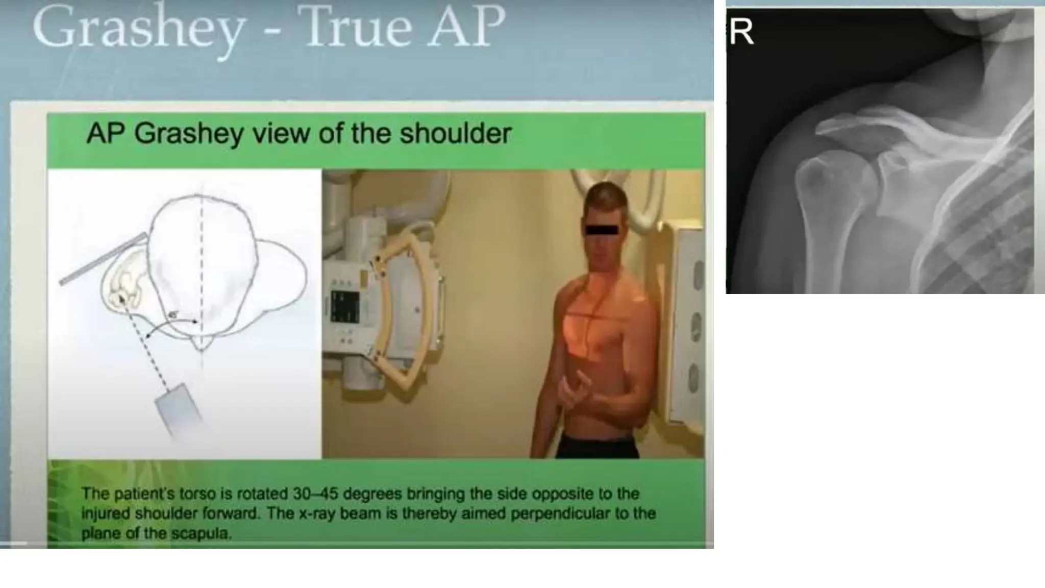 PROXIMAL HUMERUS FRACTURE TREATMENT.pptx
