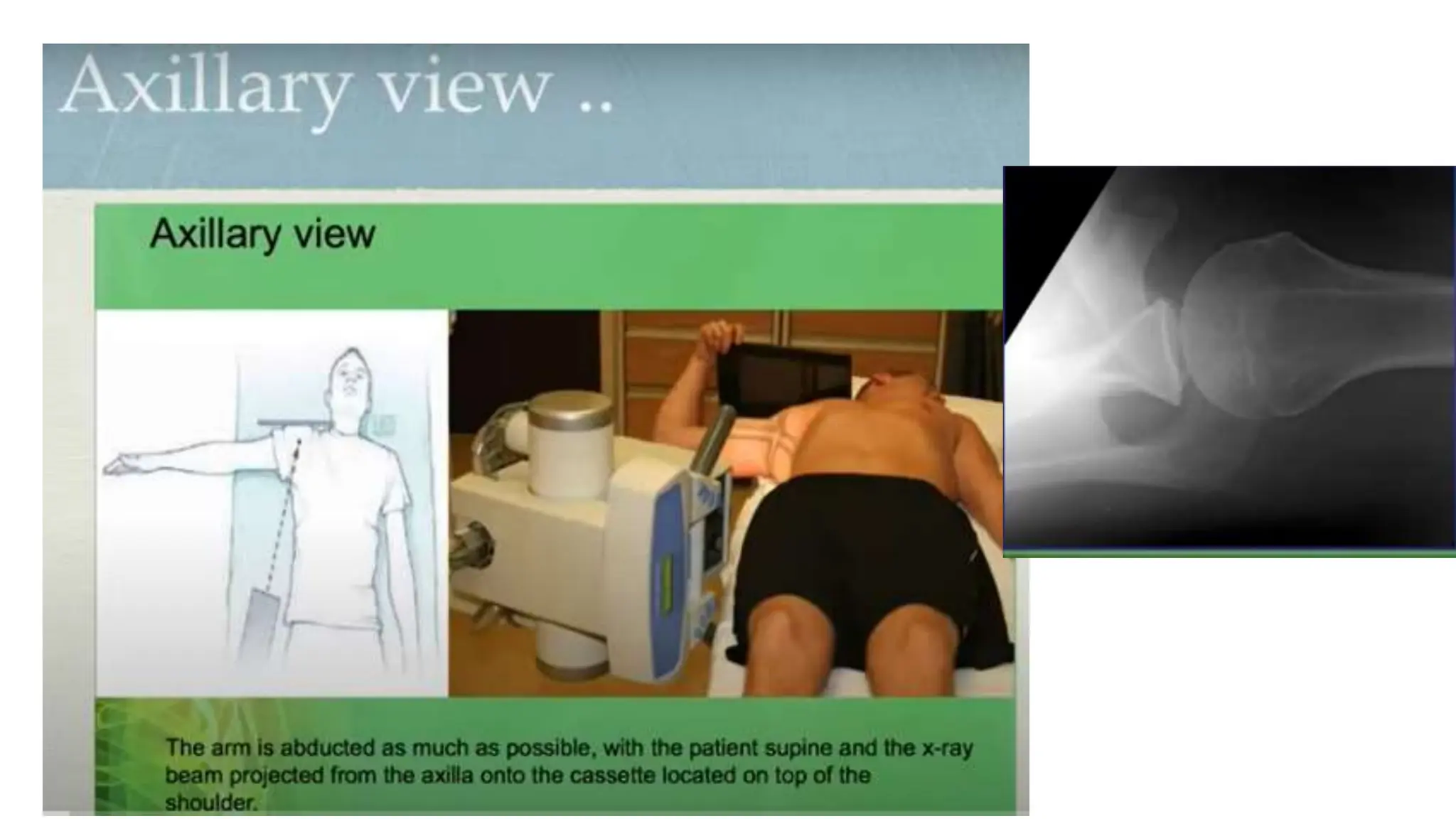 PROXIMAL HUMERUS FRACTURE TREATMENT.pptx
