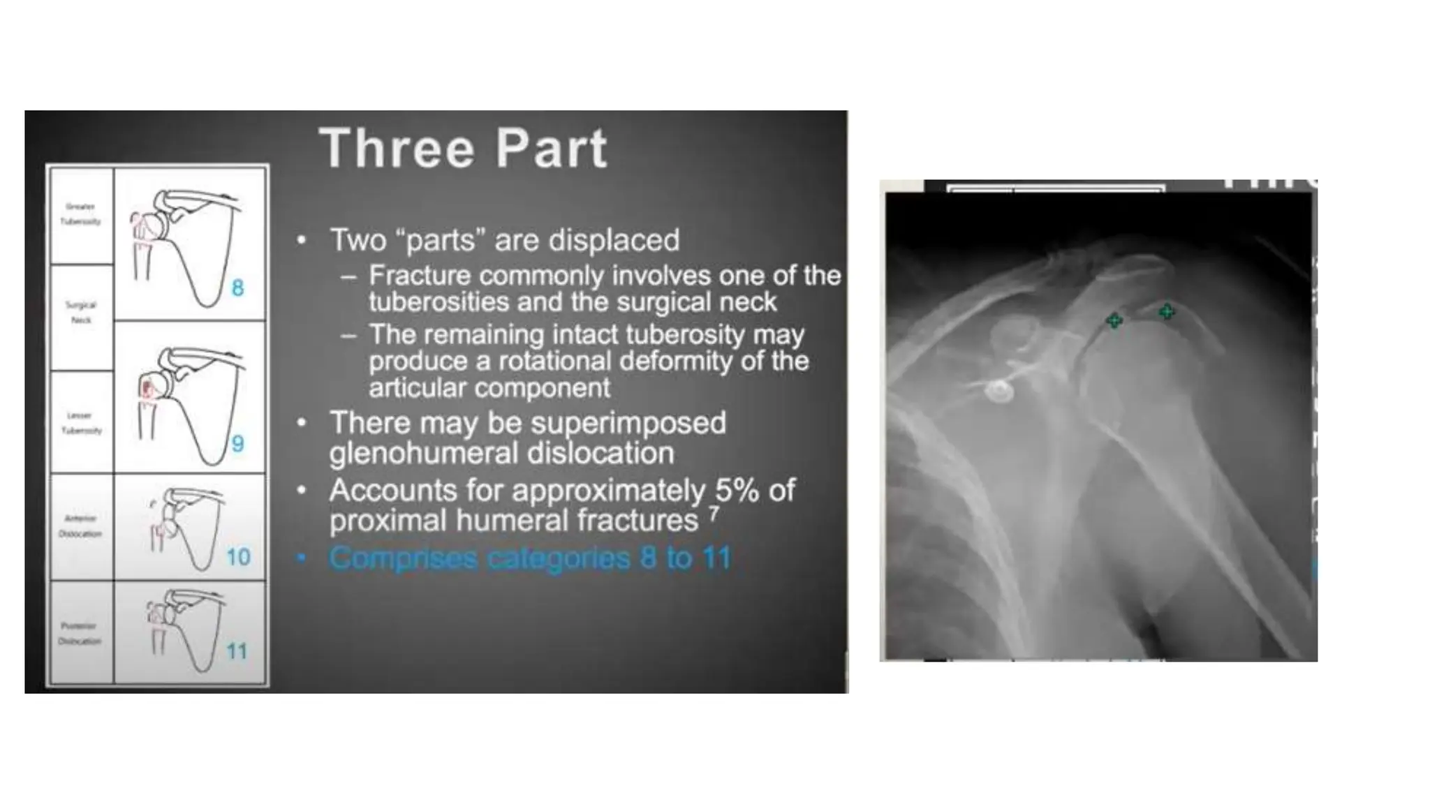 PROXIMAL HUMERUS FRACTURE TREATMENT.pptx