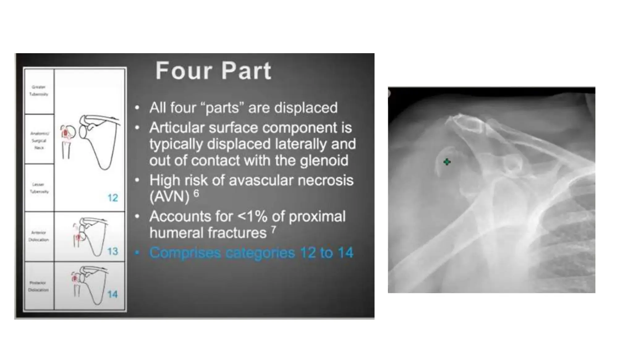PROXIMAL HUMERUS FRACTURE TREATMENT.pptx