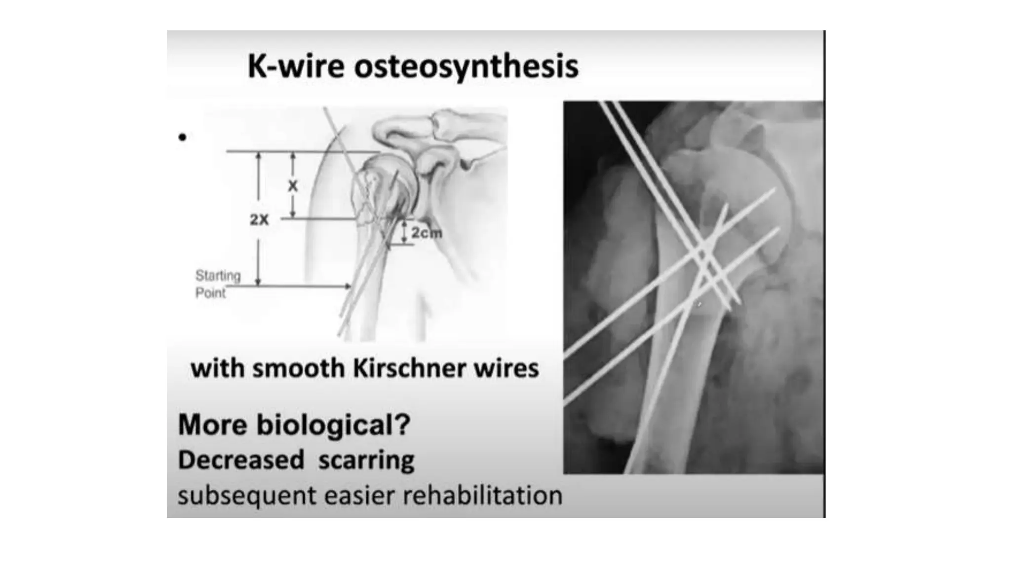 PROXIMAL HUMERUS FRACTURE TREATMENT.pptx