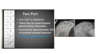 PROXIMAL HUMERUS FRACTURE TREATMENT.pptx