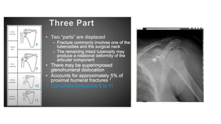 PROXIMAL HUMERUS FRACTURE TREATMENT.pptx