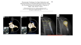 PROXIMAL HUMERUS FRACTURE TREATMENT.pptx