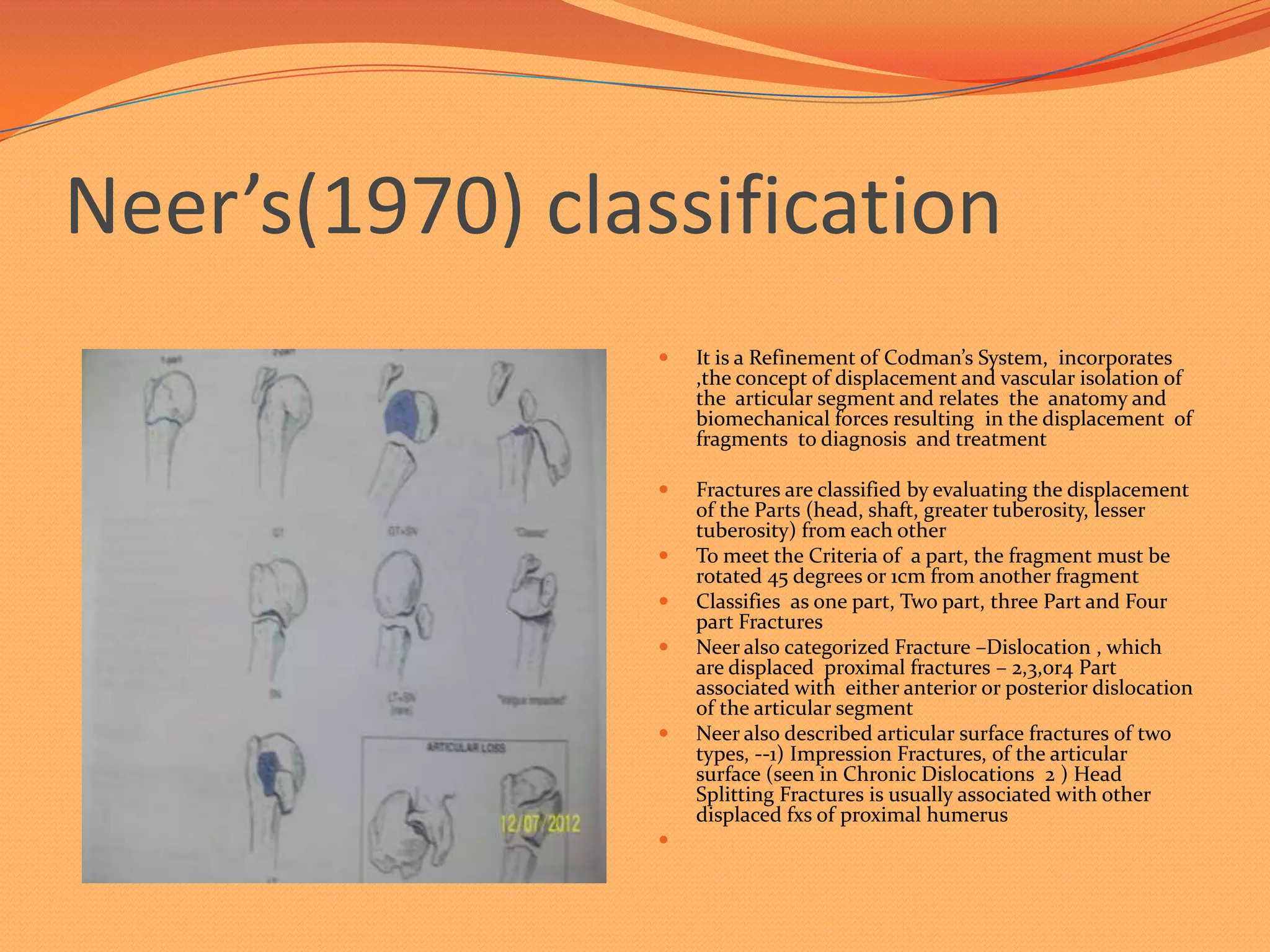 Proximal humerus fracture Management | PPTX