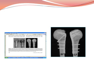 Proximal humerus fracture Management | PPTX