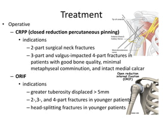 Treatment
• Operative
– CRPP (closed reduction percutaneous pinning)
• indications
– 2-part surgical neck fractures
– 3-part and valgus-impacted 4-part fractures in
patients with good bone quality, minimal
metaphyseal comminution, and intact medial calcar
– ORIF
• indications
– greater tuberosity displaced > 5mm
– 2-,3-, and 4-part fractures in younger patients
– head-splitting fractures in younger patients
 