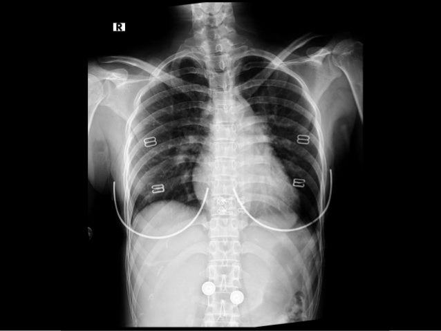 finger on the y pulse Proximal fracture humerus