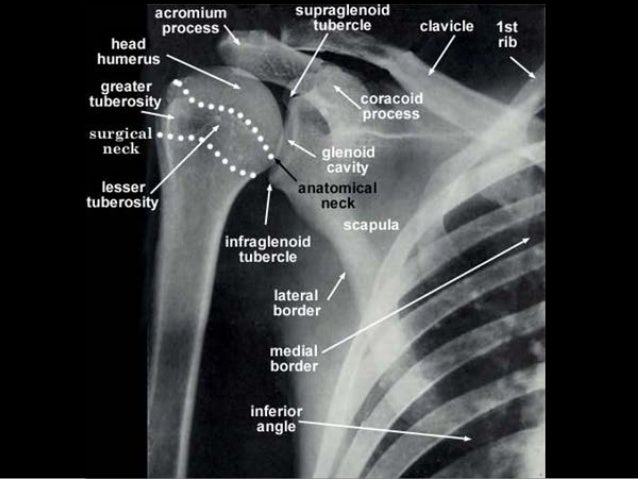 closed fracture of proximal end of right humerus closed fracture of proximal end of right humerus