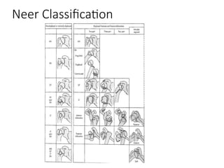 Nehr Classification Proximal humerus fracture approach and dangerpptx | PPTX