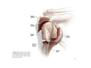 Proximal humerus fracture approach and dangerpptx | PPTX