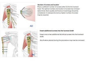 Proximal humerus fracture approach and dangerpptx | PPTX