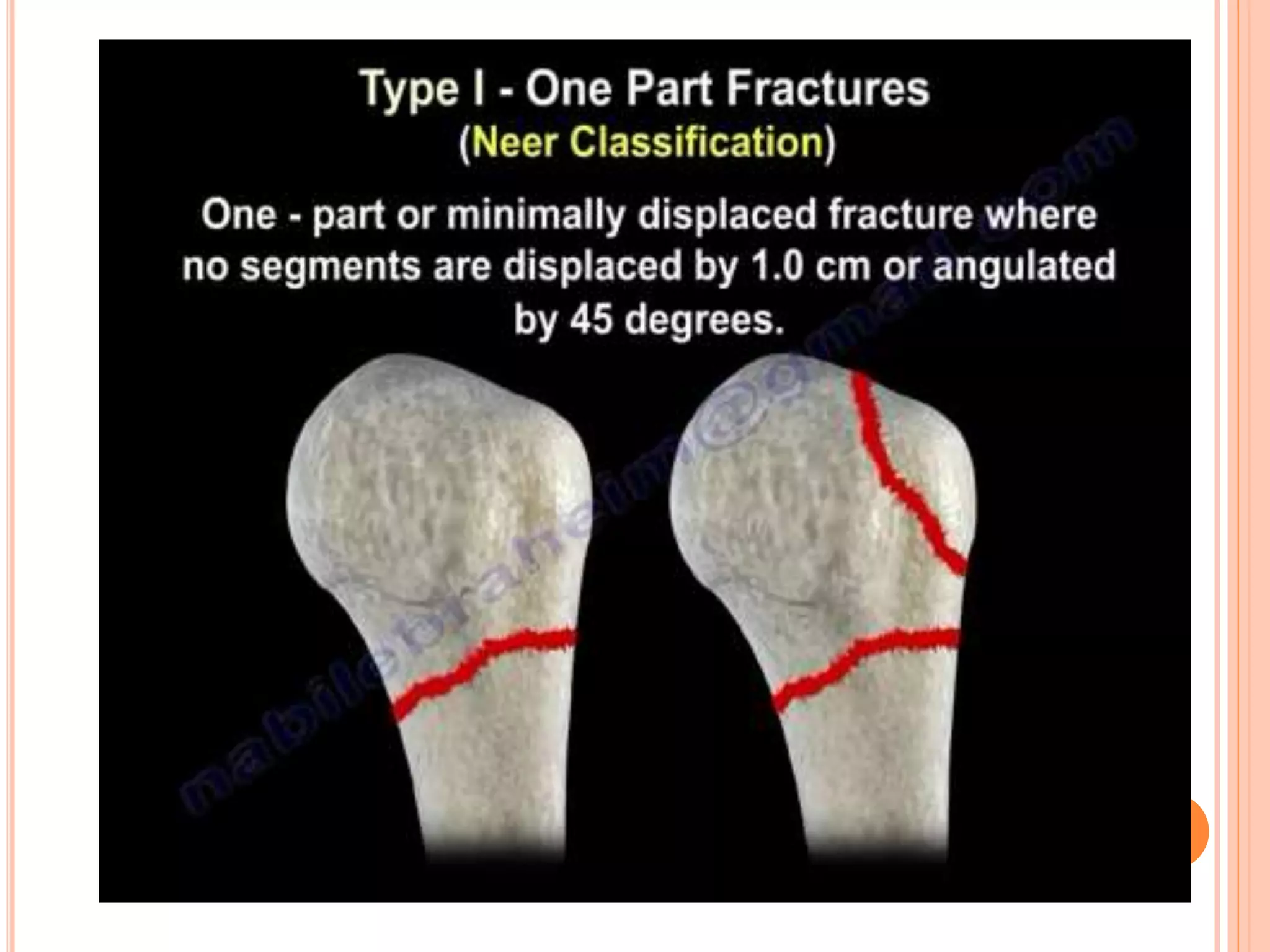 Proximal humerus fractures | PPTX