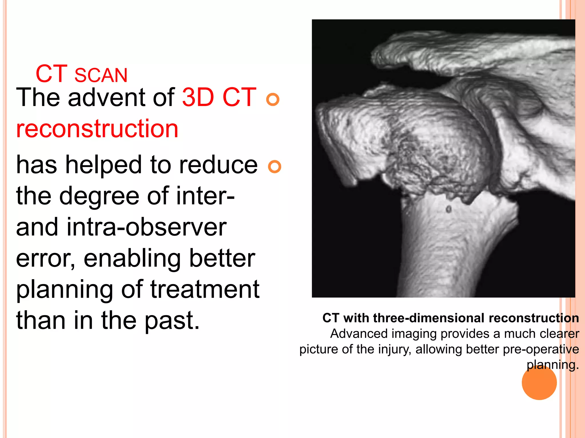 Proximal humerus fractures | PPTX