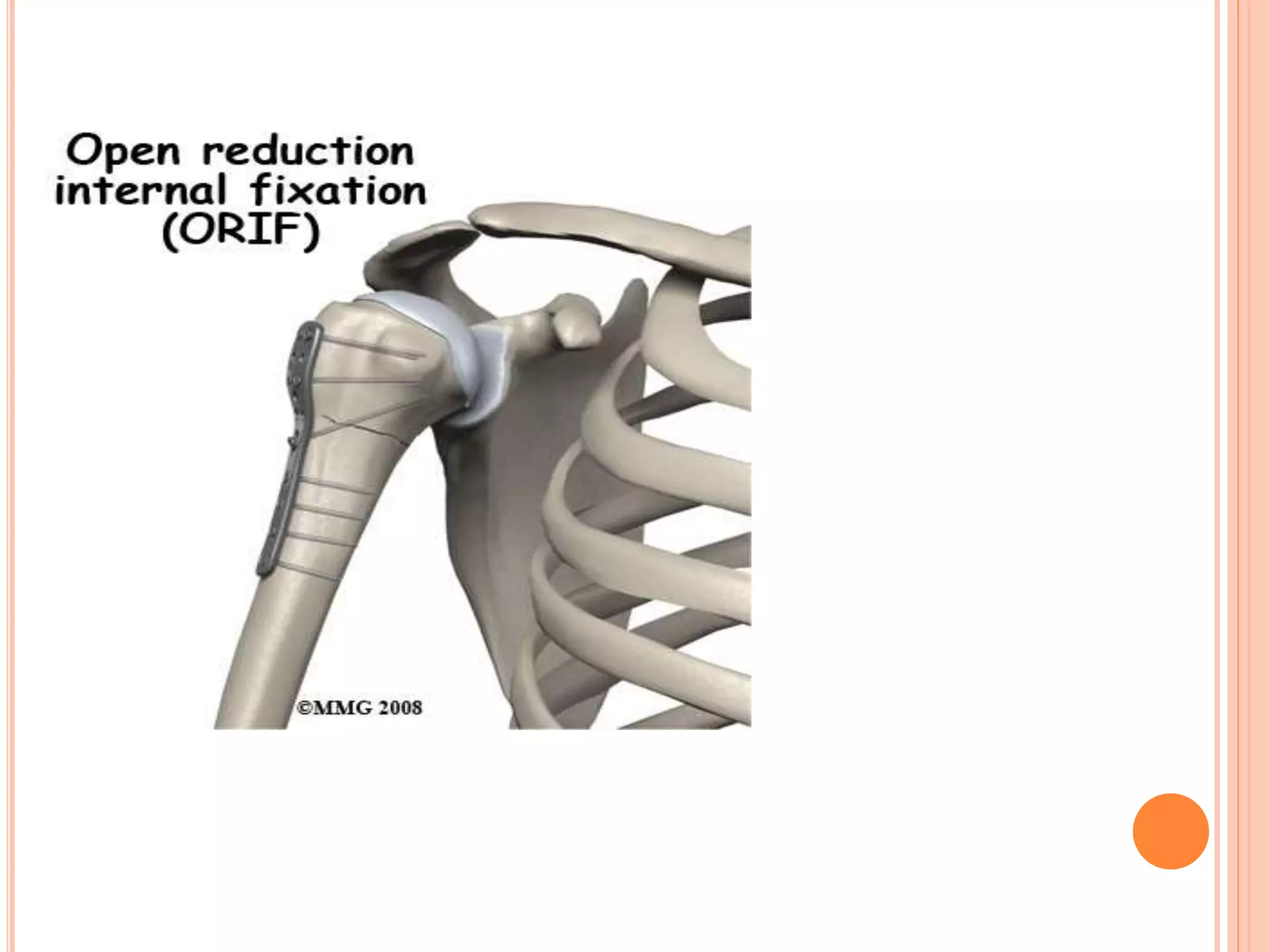 Proximal humerus fractures | PPTX
