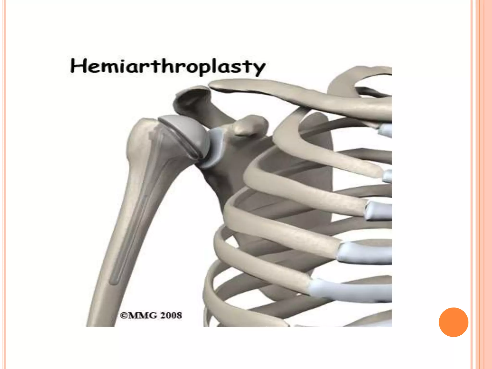 Proximal humerus fractures | PPTX