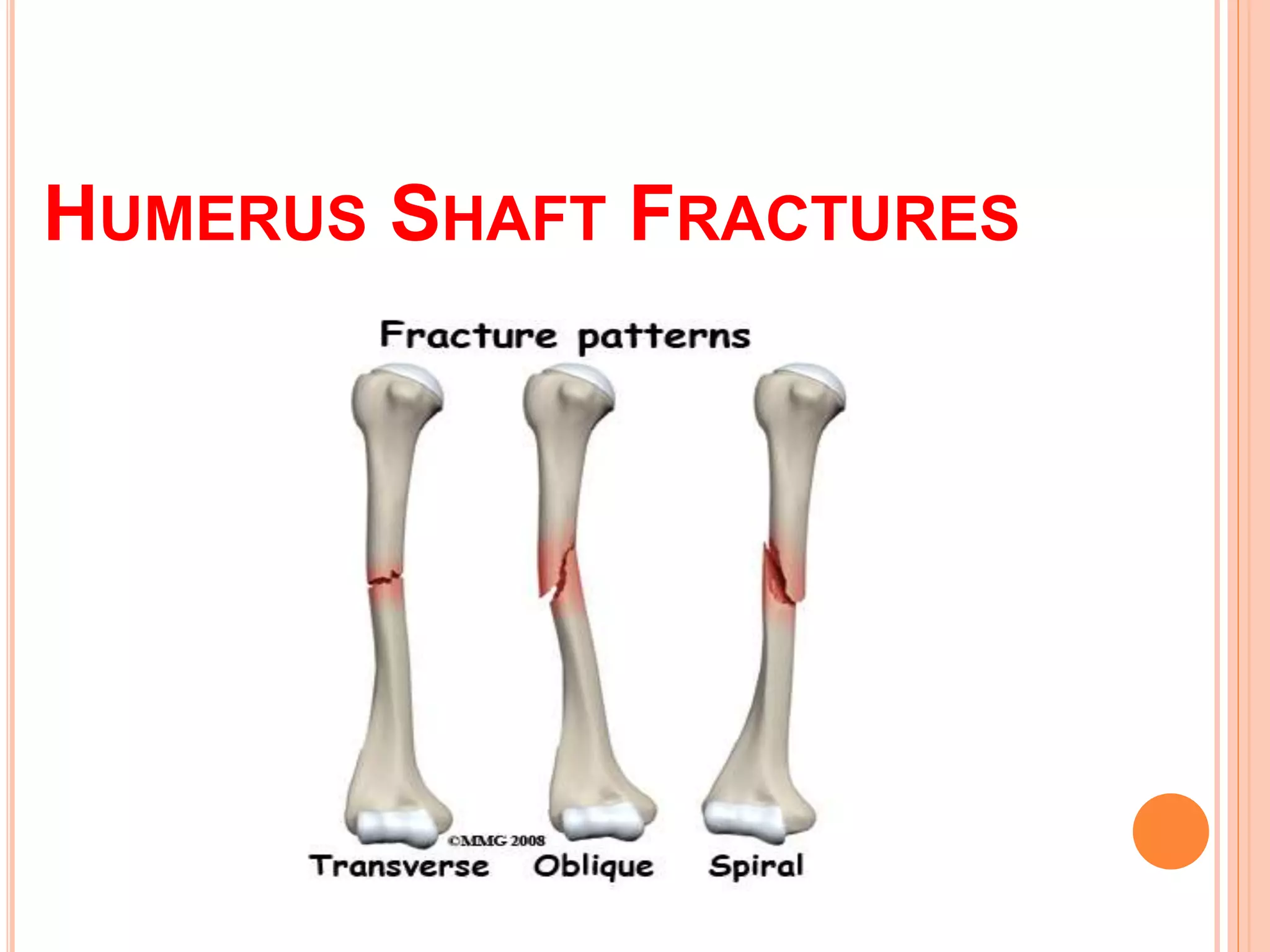 Proximal humerus fractures | PPTX
