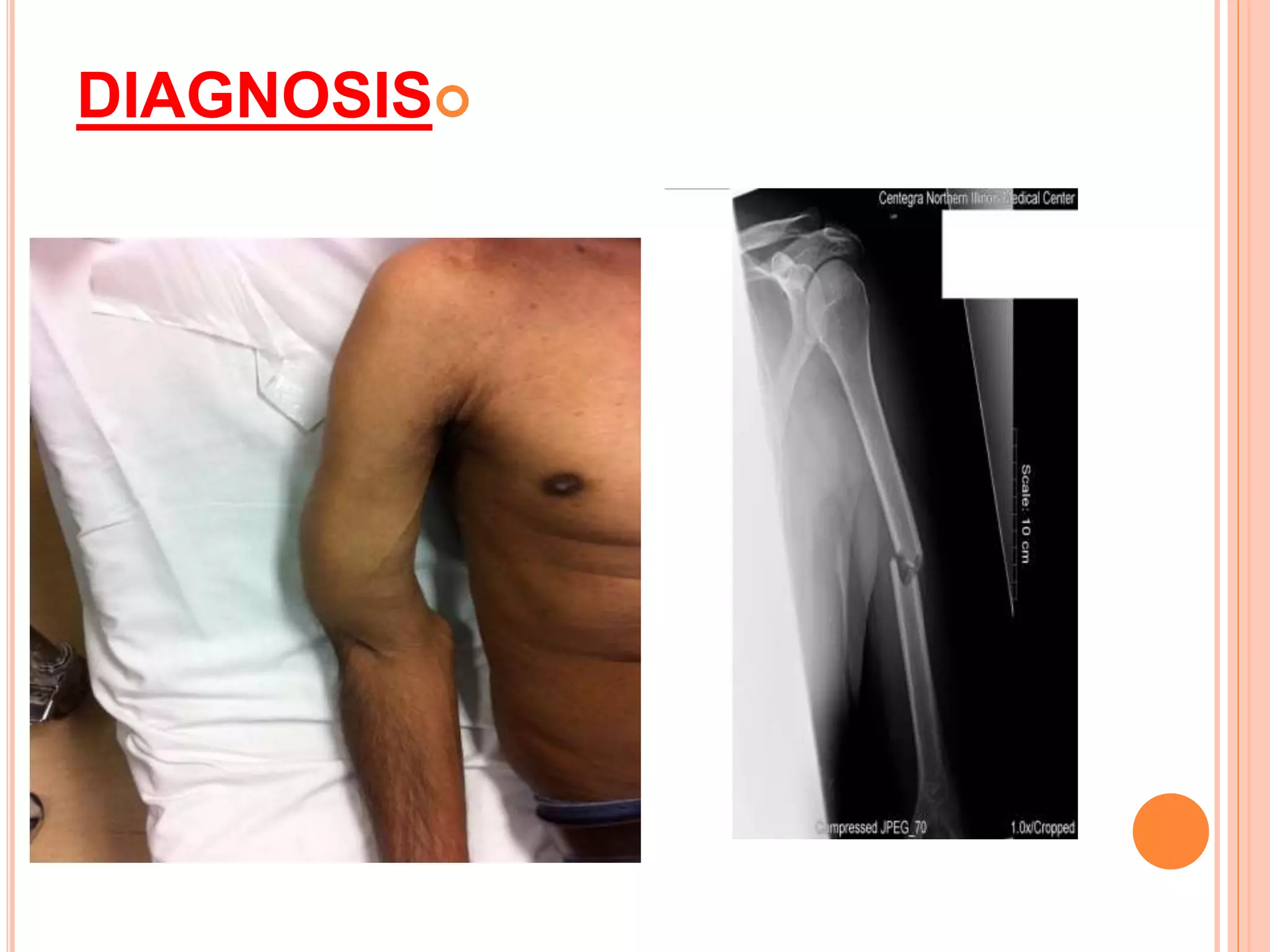 Proximal humerus fractures | PPTX
