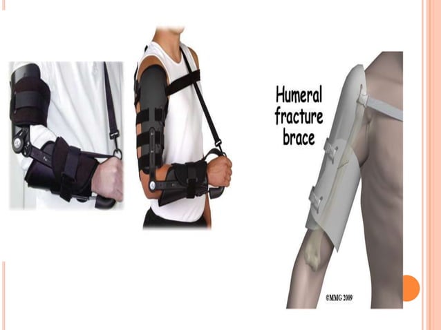 Proximal humerus fractures | PPTX