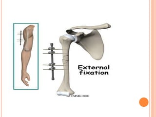Proximal humerus fractures | PPTX