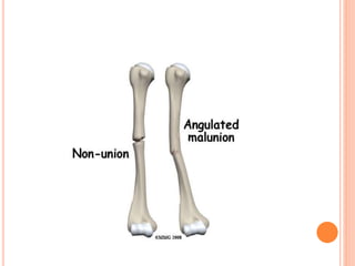 Proximal humerus fractures | PPTX