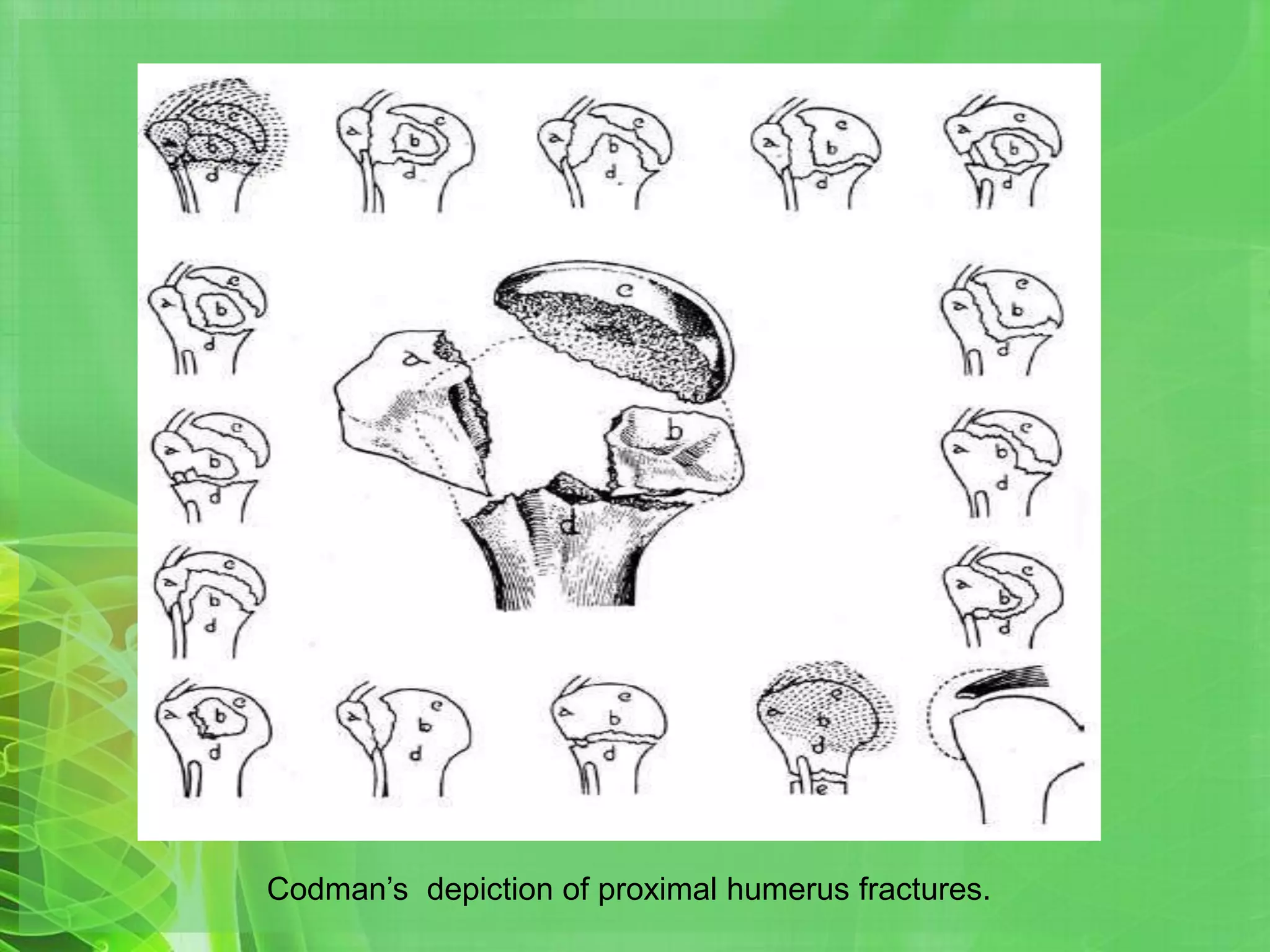 Proximal humerus fractures | PPTX