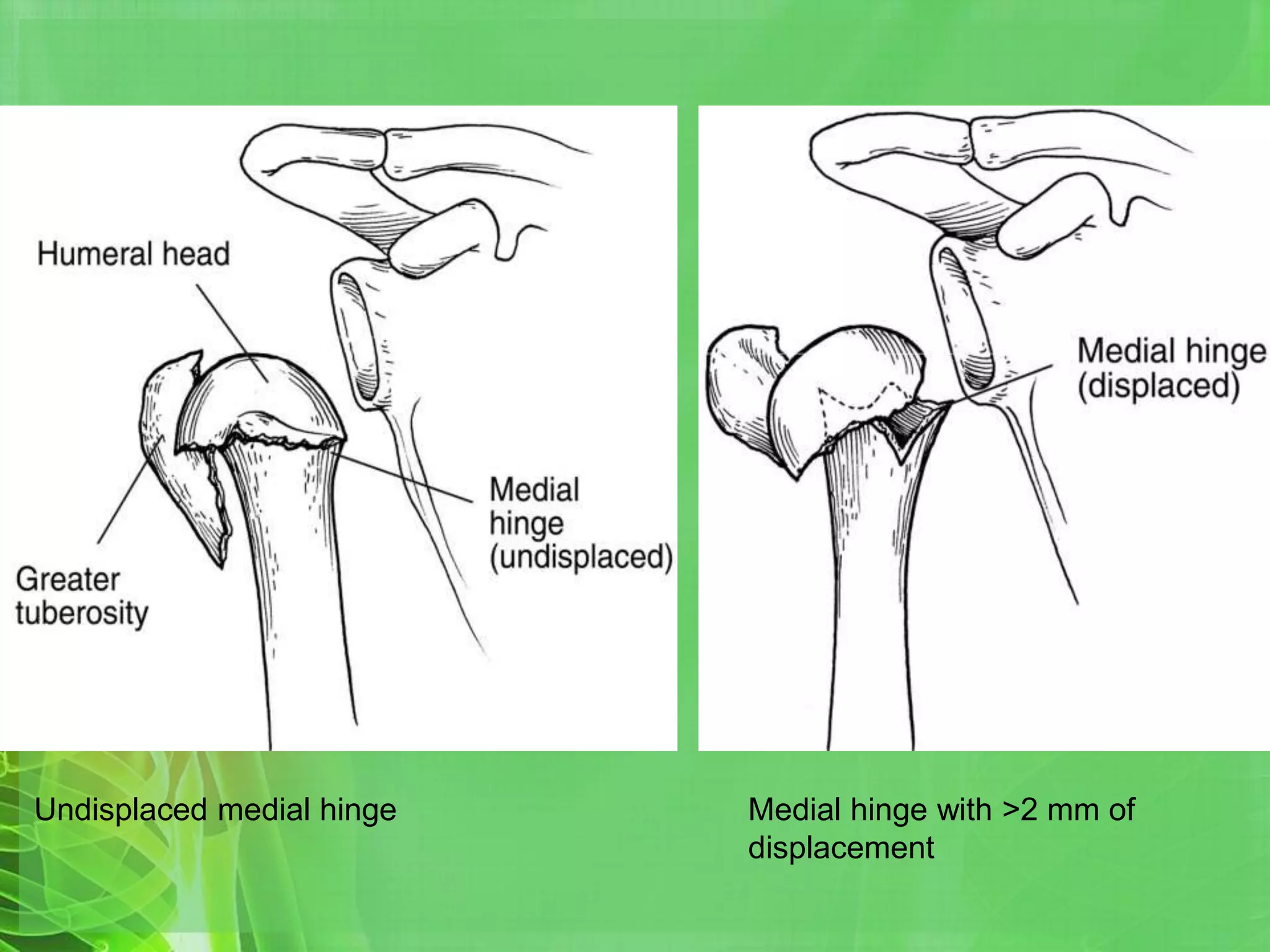 Proximal humerus fractures | PPTX
