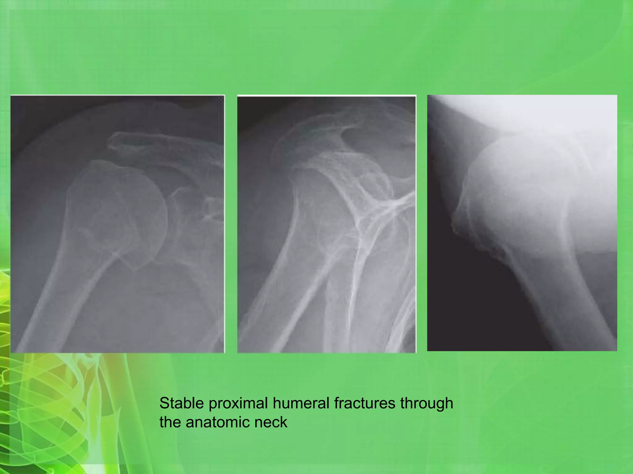 Proximal humerus fractures | PPTX