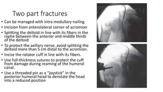 Two part fractures
• Can be managed with intra medullary nailing
• Incision from anterolateral corner of acromion
• Splitting the deltoid in line with its fibers in the
raphe between the anterior and middle thirds
of the deltoid
• To protect the axillary nerve, avoid splitting the
deltoid more than 5 cm distal to the acromion.
• Incise the rotator cuff in line with its fibers.
• Use full-thickness sutures to protect the cuff
from damage during reaming of the humeral
canal.
• Use a threaded pin as a “joystick” in the
posterior humeral head to derotate the head
into a reduced position
 