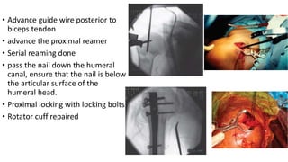 • Advance guide wire posterior to
biceps tendon
• advance the proximal reamer
• Serial reaming done
• pass the nail down the humeral
canal, ensure that the nail is below
the articular surface of the
humeral head.
• Proximal locking with locking bolts
• Rotator cuff repaired
 