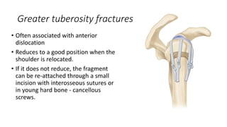 Greater tuberosity fractures
• Often associated with anterior
dislocation
• Reduces to a good position when the
shoulder is relocated.
• If it does not reduce, the fragment
can be re-attached through a small
incision with interosseous sutures or
in young hard bone - cancellous
screws.
 