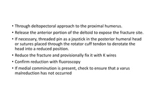 • Through deltopectoral approach to the proximal humerus.
• Release the anterior portion of the deltoid to expose the fracture site.
• If necessary, threaded pin as a joystick in the posterior humeral head
or sutures placed through the rotator cuff tendon to derotate the
head into a reduced position.
• Reduce the fracture and provisionally fix it with K wires
• Confirm reduction with fluoroscopy
• If medial comminution is present, check to ensure that a varus
malreduction has not occurred
 