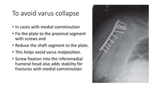 To avoid varus collapse
• In cases with medial comminution
• Fix the plate to the proximal segment
with screws and
• Reduce the shaft segment to the plate.
• This helps avoid varus malposition.
• Screw fixation into the inferomedial
humeral head also adds stability for
fractures with medial comminution
 