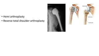 • Hemi arthroplasty
• Reverse total shoulder arthroplasty
 