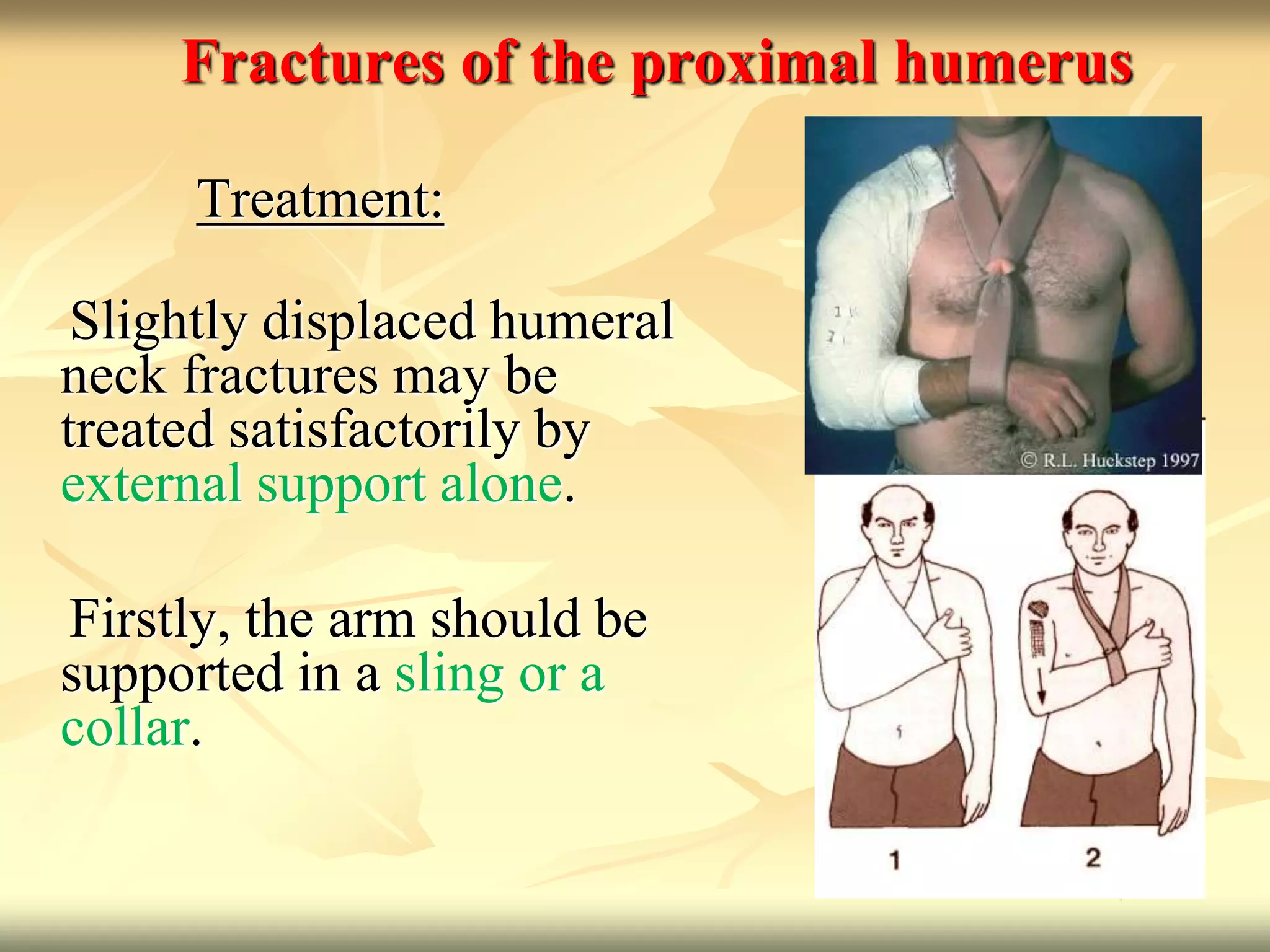 Proximal humerus fractures | PPTX