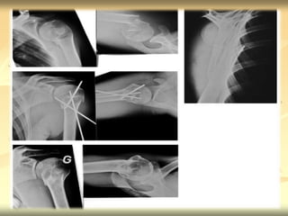 Proximal humerus fractures | PPTX