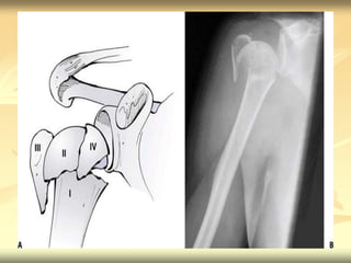 Proximal humerus fractures | PPTX