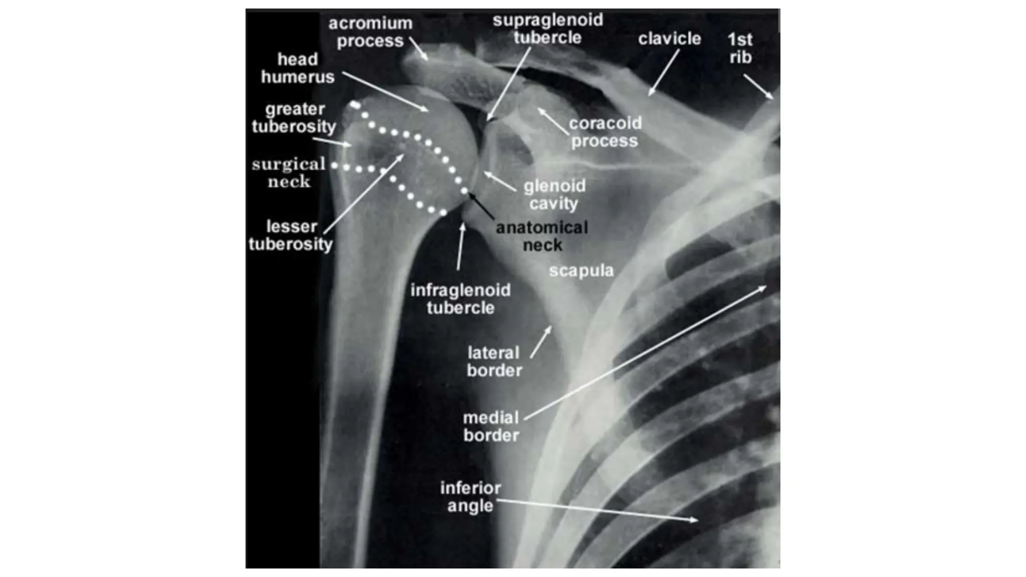 Upper limb trauma : Proximal Humerus Fractures | PPT