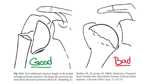 Upper limb trauma : Proximal Humerus Fractures | PPT