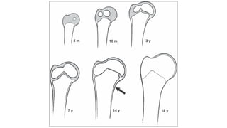 Upper limb trauma : Proximal Humerus Fractures | PDF