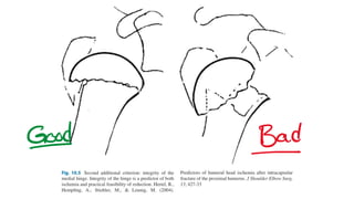 Upper limb trauma : Proximal Humerus Fractures | PDF