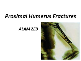 Proximal Humerus Fractures
ALAM ZEB
 