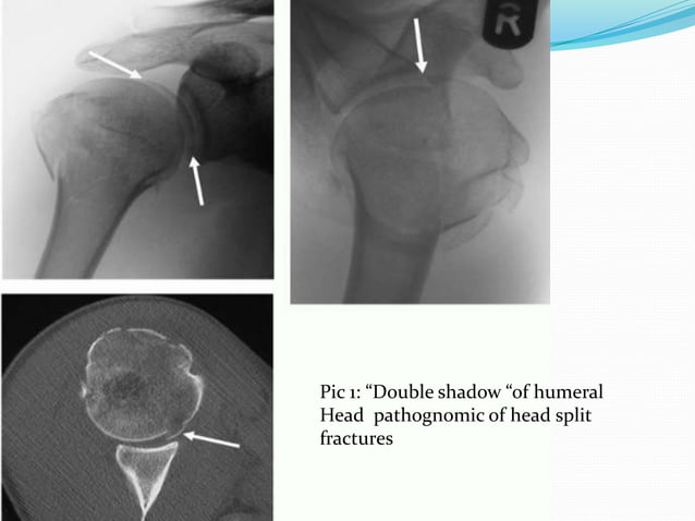 Proximal humerus fractures anatomy and classification | PPT