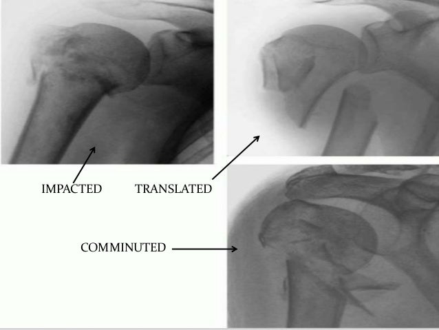 Proximal humerus fractures anatomy and classification