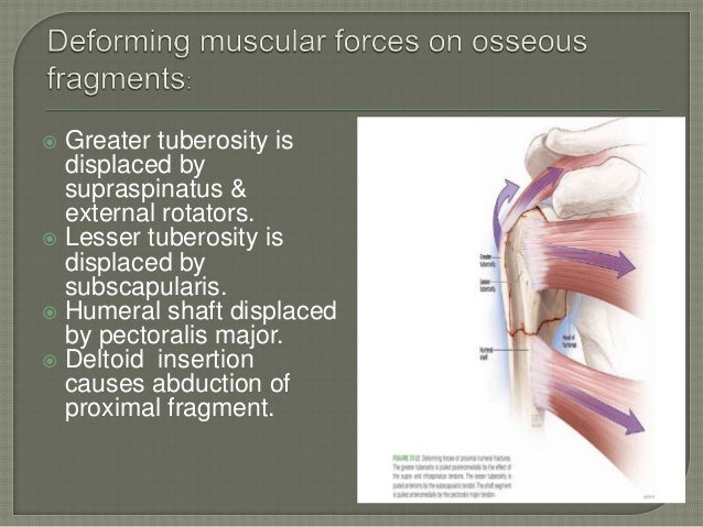 Proximal humerus fractures by krr