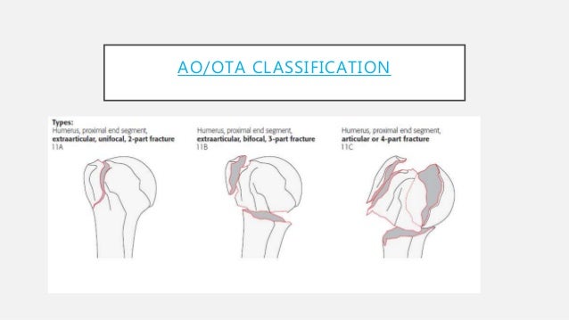 Proximal Humerus Fractures Proximal Humerus Fractures