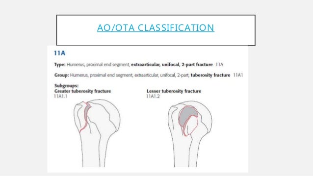 Proximal Humerus Fractures