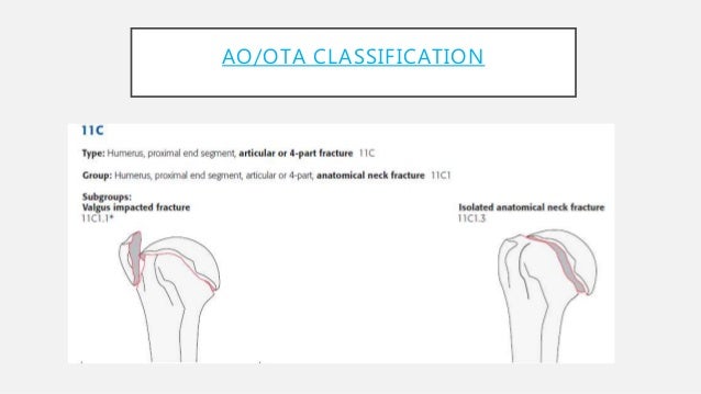 Proximal Humerus Fractures Proximal Humerus Fractures