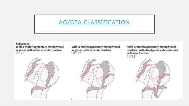 Proximal Humerus Fractures Proximal Humerus Fractures